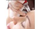 Best Microneedling treatment in West Watford