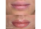 Best Service For Lips in Marleybone